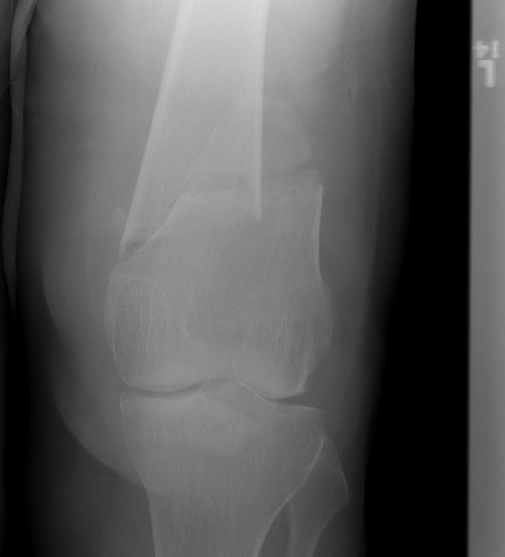 Supracondylar Femur Fracture Retrograde Nail0002